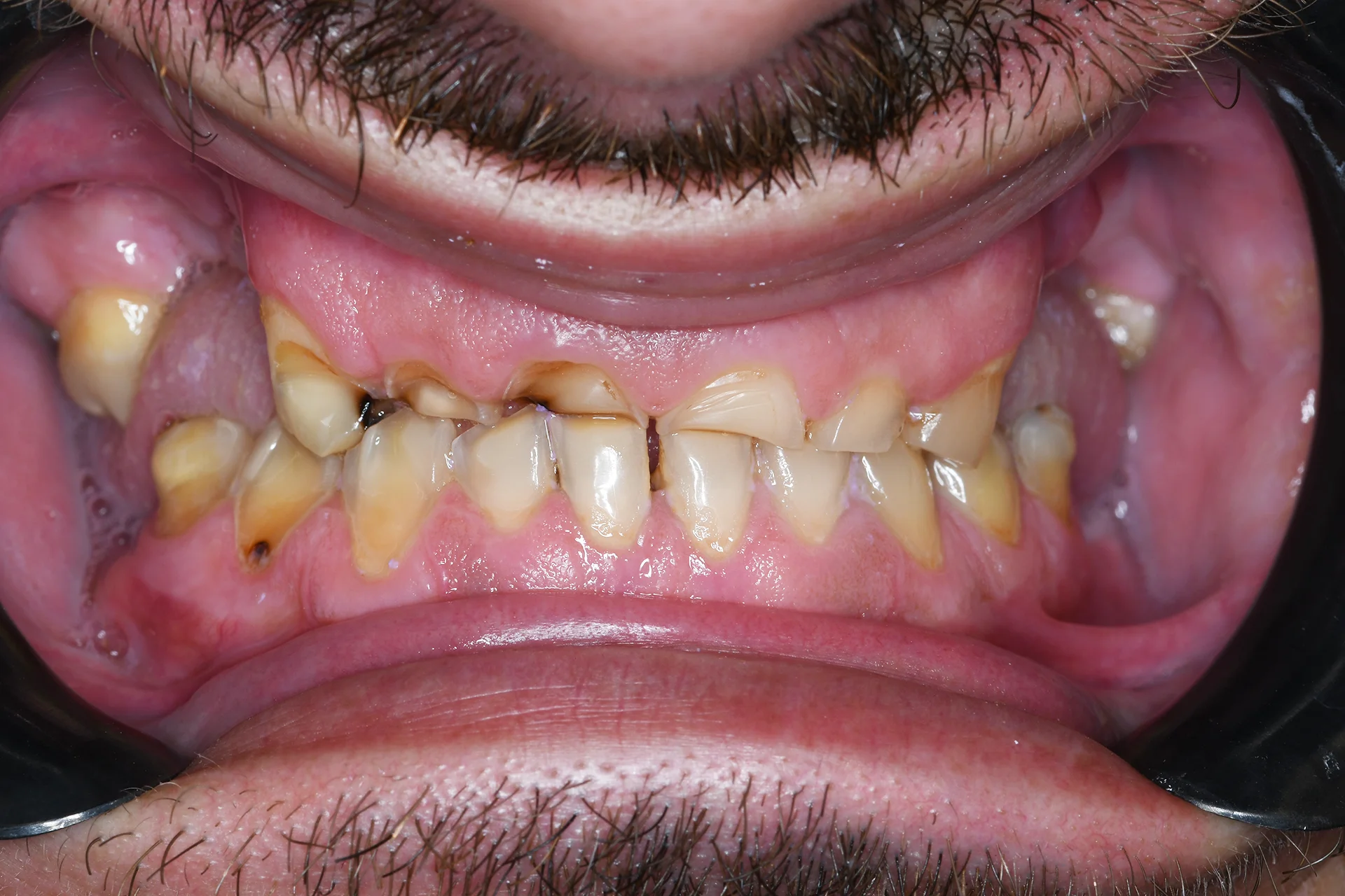 cirkonske krunice na implantatima