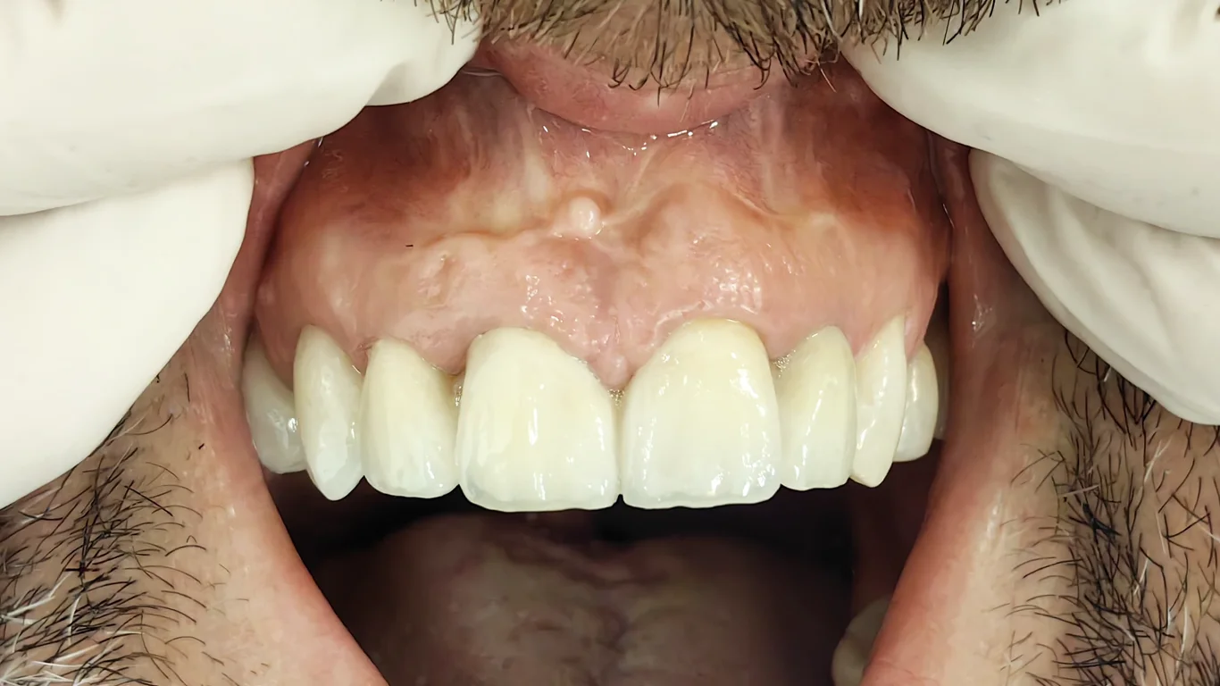 Zatvaranje prostora zubnog mesa